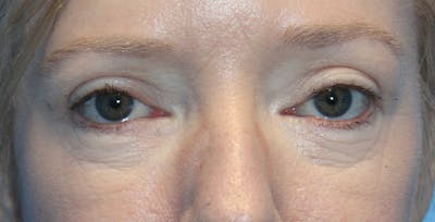 Eye Surgery Before & After Gallery - Patient 236279 - Image 2