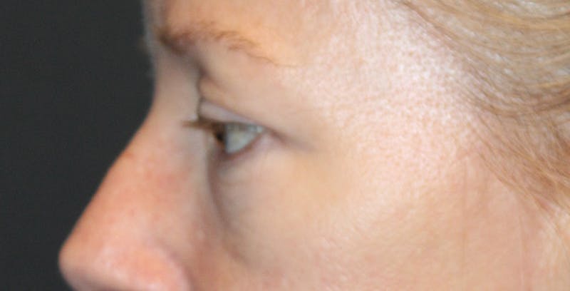 Eye Surgery Before & After Gallery - Patient 236279 - Image 3