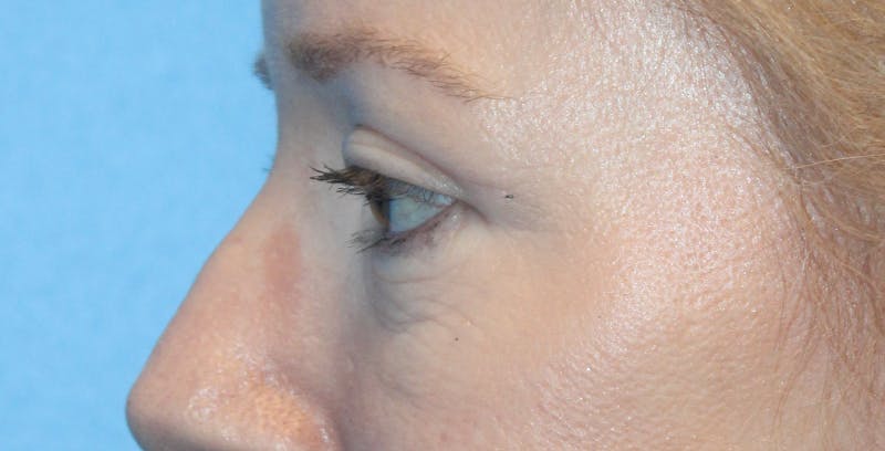 Eye Surgery Before & After Gallery - Patient 236279 - Image 4