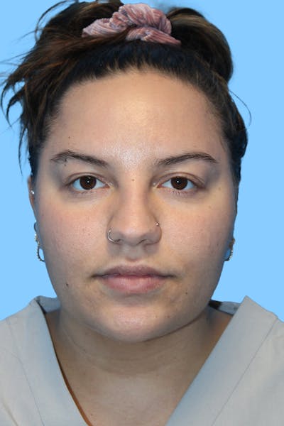 FaceTite Before & After Gallery - Patient 104864 - Image 2