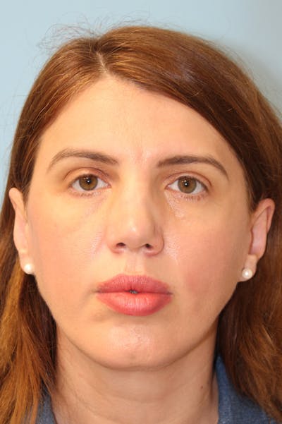 Revision Rhinoplasty Before & After Gallery - Patient 256865 - Image 1