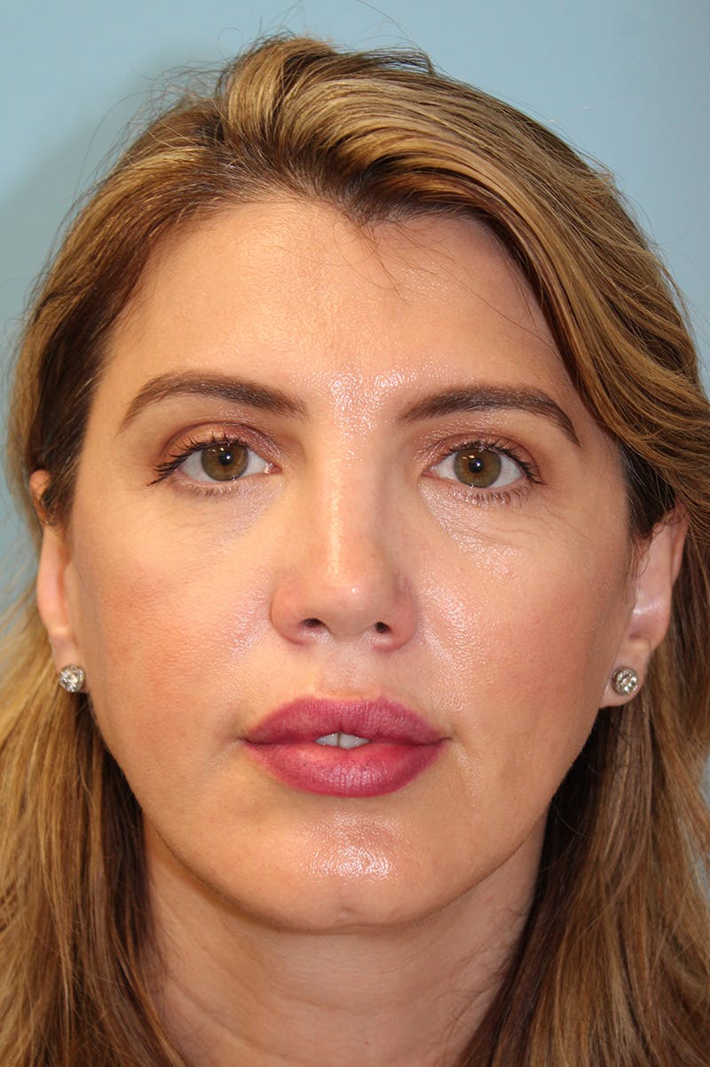 Revision Rhinoplasty Before & After Gallery - Patient 256865 - Image 2