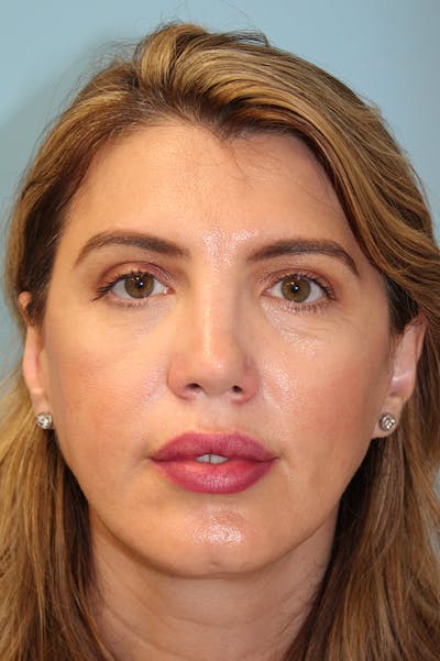 Revision Rhinoplasty Before & After Gallery - Patient 256865 - Image 2