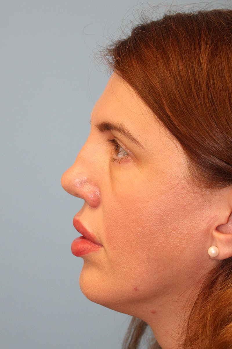 Revision Rhinoplasty Before & After Gallery - Patient 256865 - Image 3