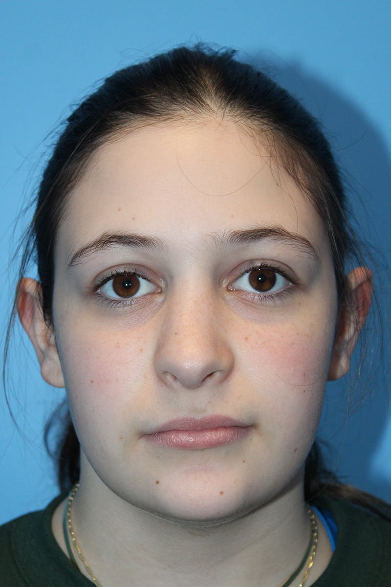 Rhinoplasty Before & After Gallery - Patient 472651 - Image 4