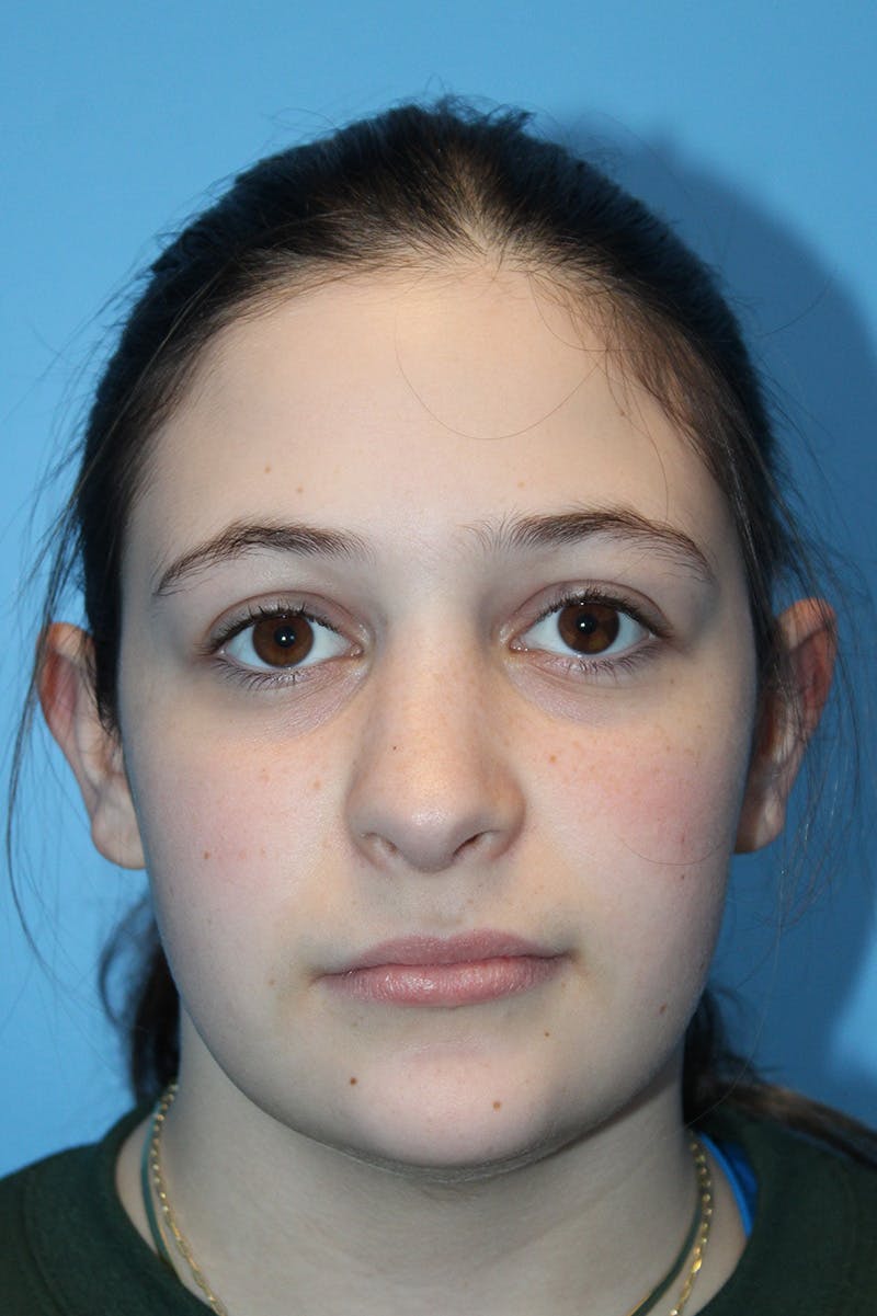 Rhinoplasty Before & After Gallery - Patient 472651 - Image 4
