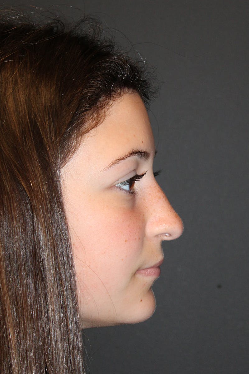 Rhinoplasty Before & After Gallery - Patient 472651 - Image 1