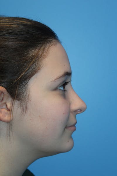 Rhinoplasty Before & After Gallery - Patient 472651 - Image 2