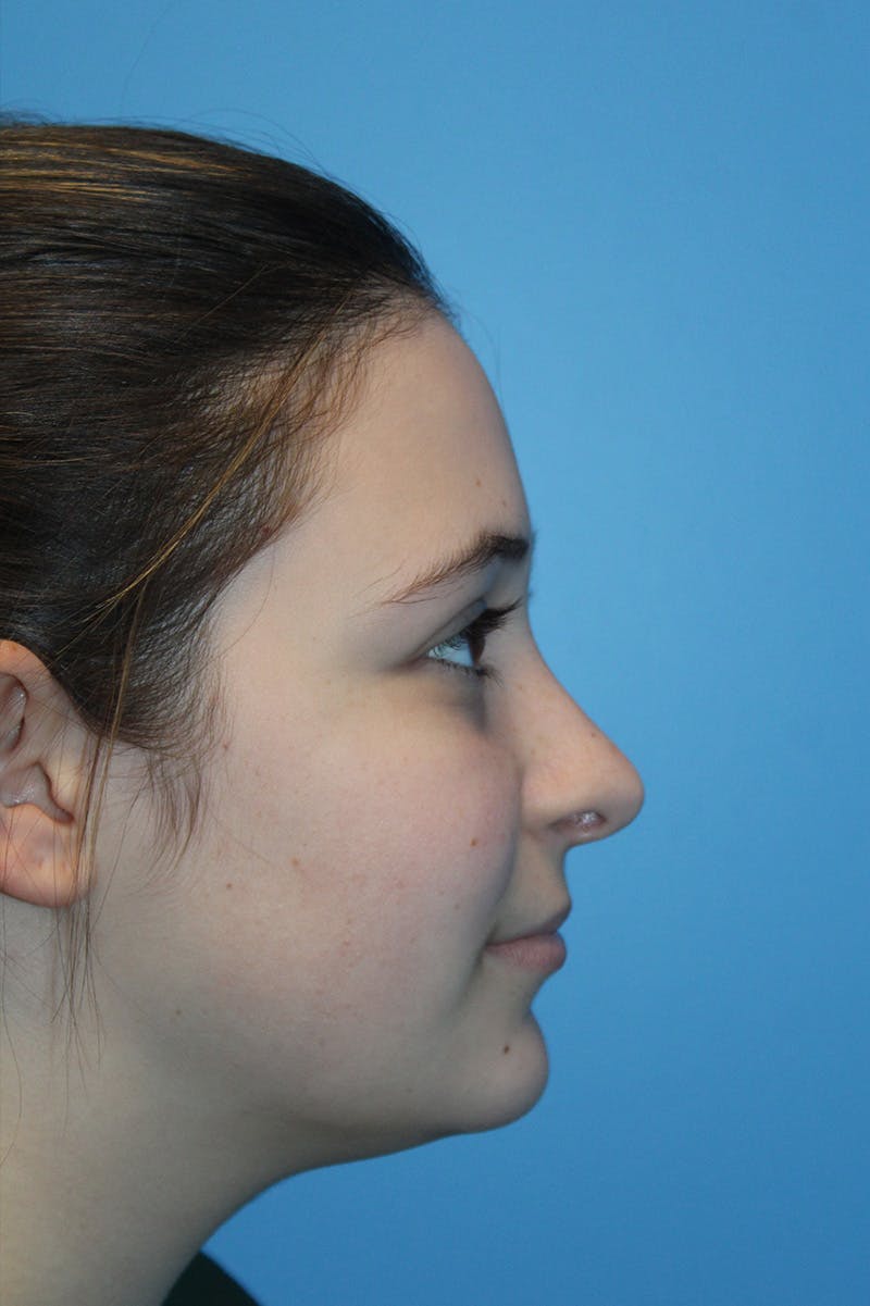 Rhinoplasty Before & After Gallery - Patient 472651 - Image 4