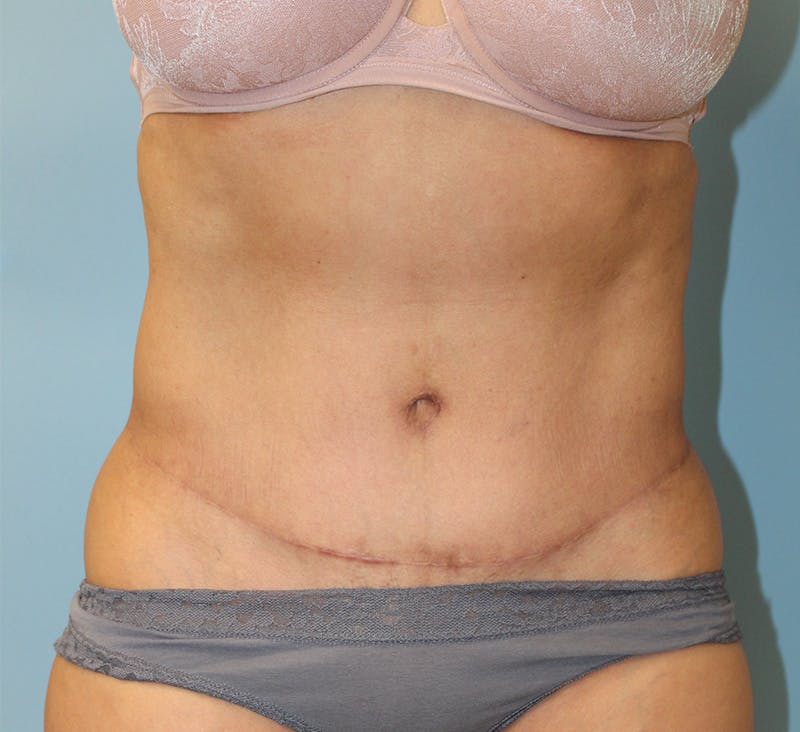 Tummy Tuck Before & After Gallery - Patient 271952 - Image 2