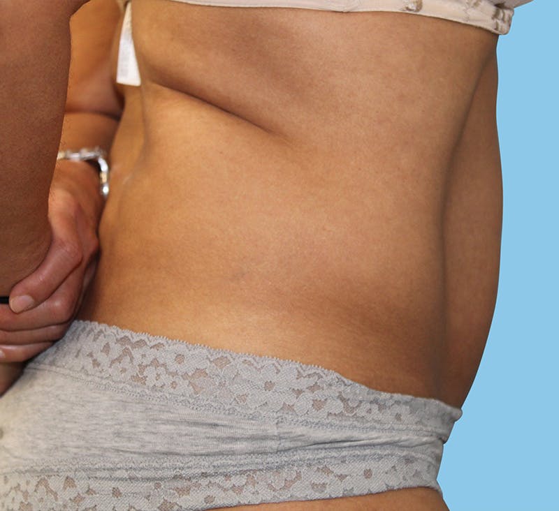 Tummy Tuck Before & After Gallery - Patient 271952 - Image 3