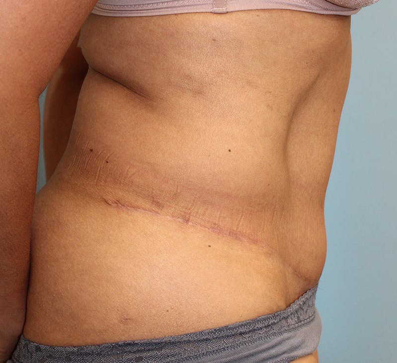 Tummy Tuck Before & After Gallery - Patient 271952 - Image 4