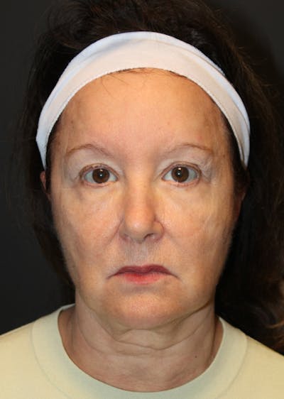 SWIFT LIFT ® / Facelift / Necklift  Before & After Gallery - Patient 296631 - Image 1