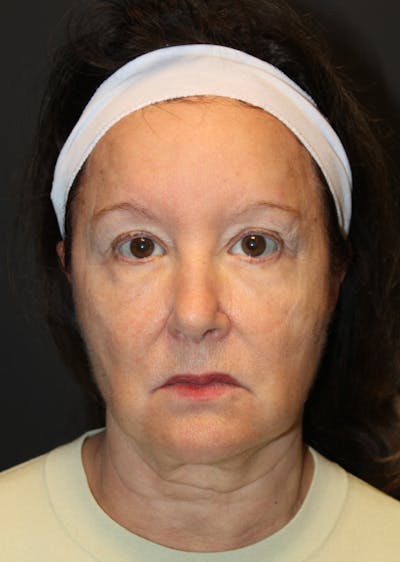 Facelift & Necklift Before & After Gallery - Patient 296631 - Image 1