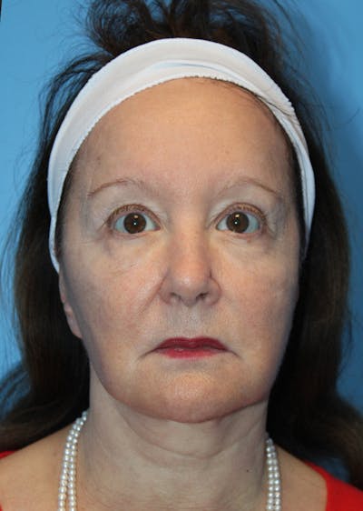 Facelift & Necklift Before & After Gallery - Patient 296631 - Image 2