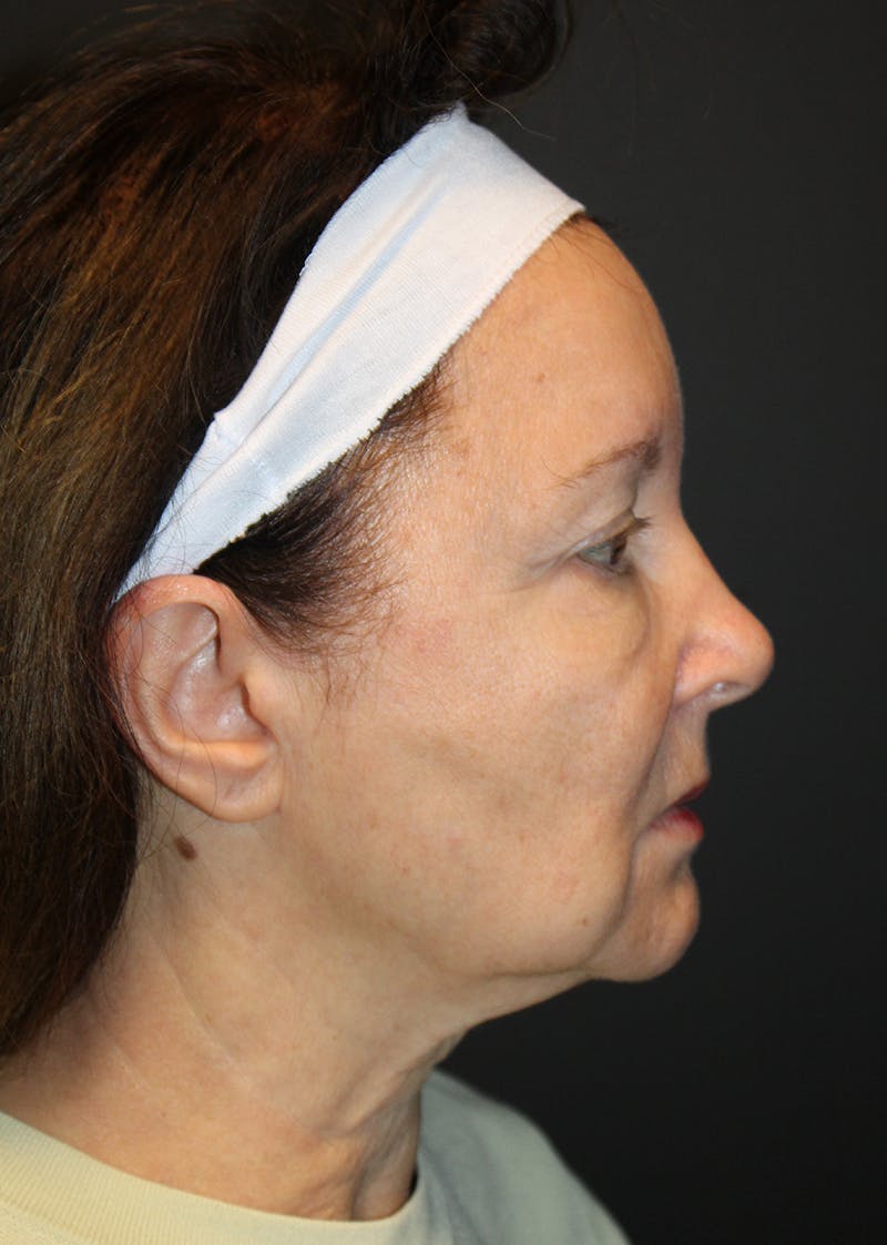 Facelift & Necklift Before & After Gallery - Patient 296631 - Image 3