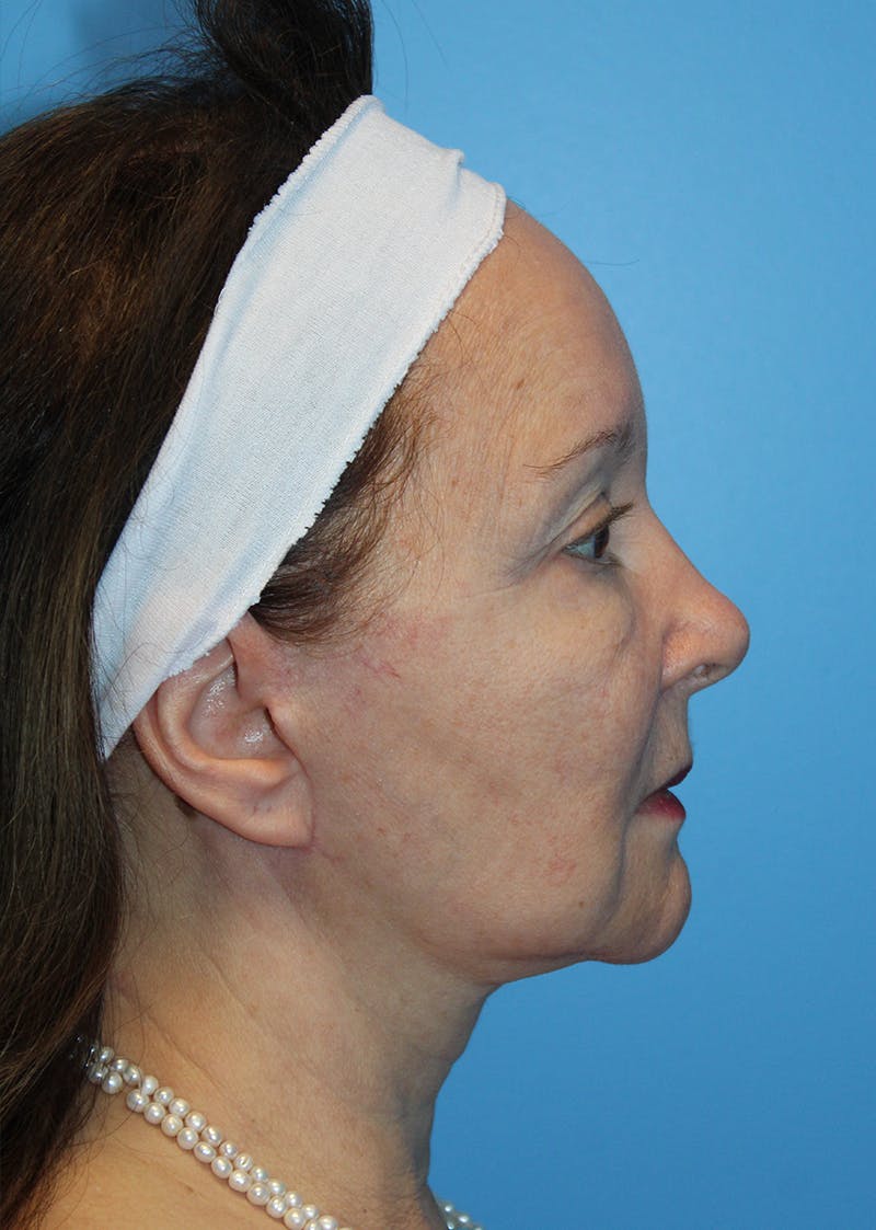 Facelift & Necklift Before & After Gallery - Patient 296631 - Image 4