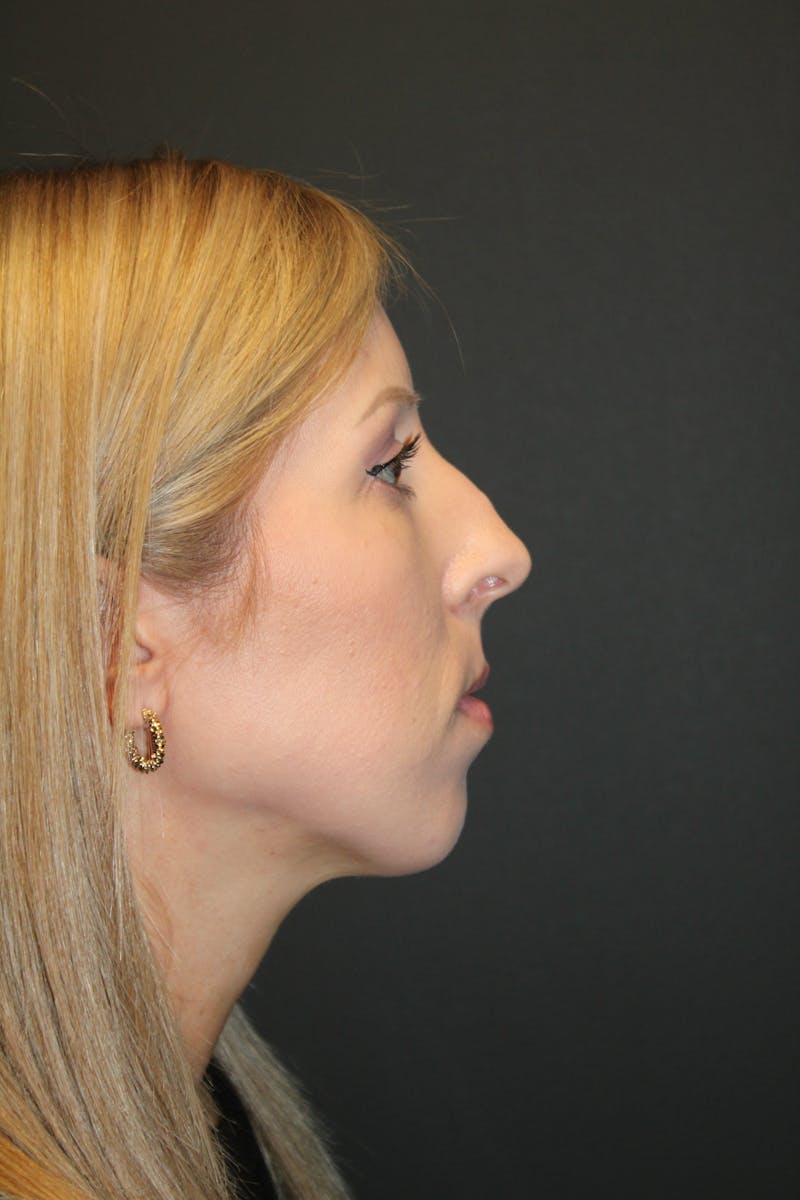 Rhinoplasty Before & After Gallery - Patient 272105 - Image 1