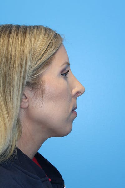 Rhinoplasty Before & After Gallery - Patient 272105 - Image 2