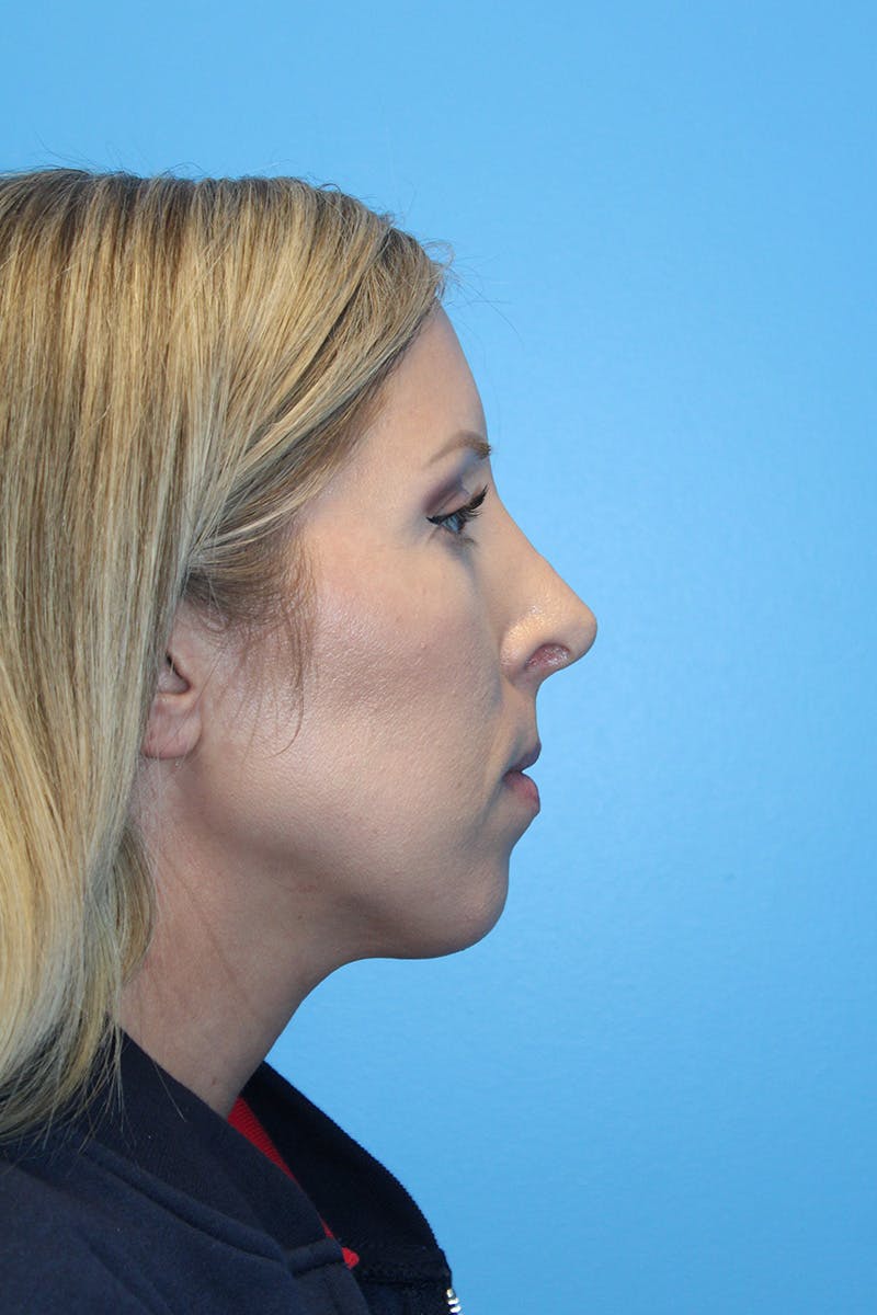 Rhinoplasty Before & After Gallery - Patient 272105 - Image 2