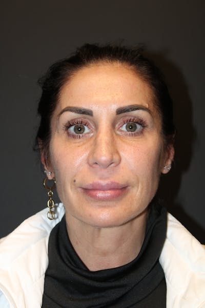 Facelift & Necklift Before & After Gallery - Patient 842820 - Image 1