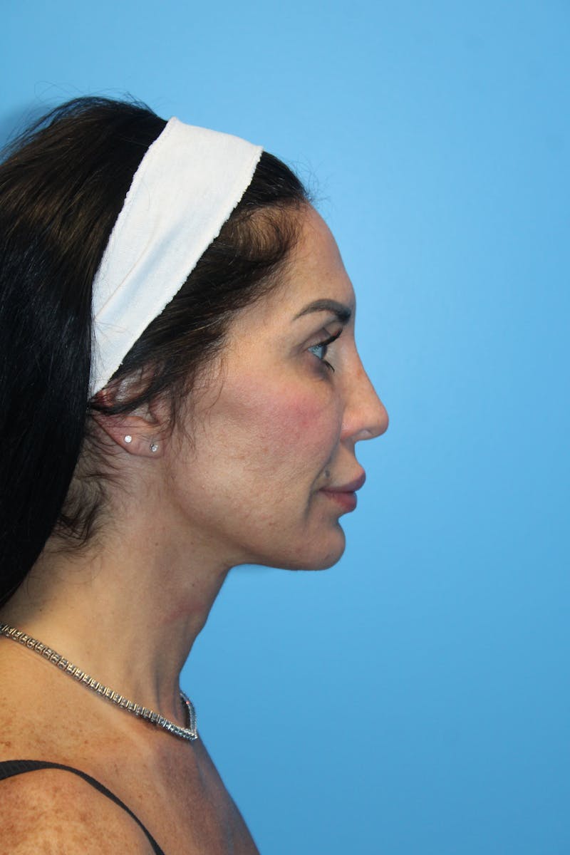 Facelift & Necklift Before & After Gallery - Patient 842820 - Image 4