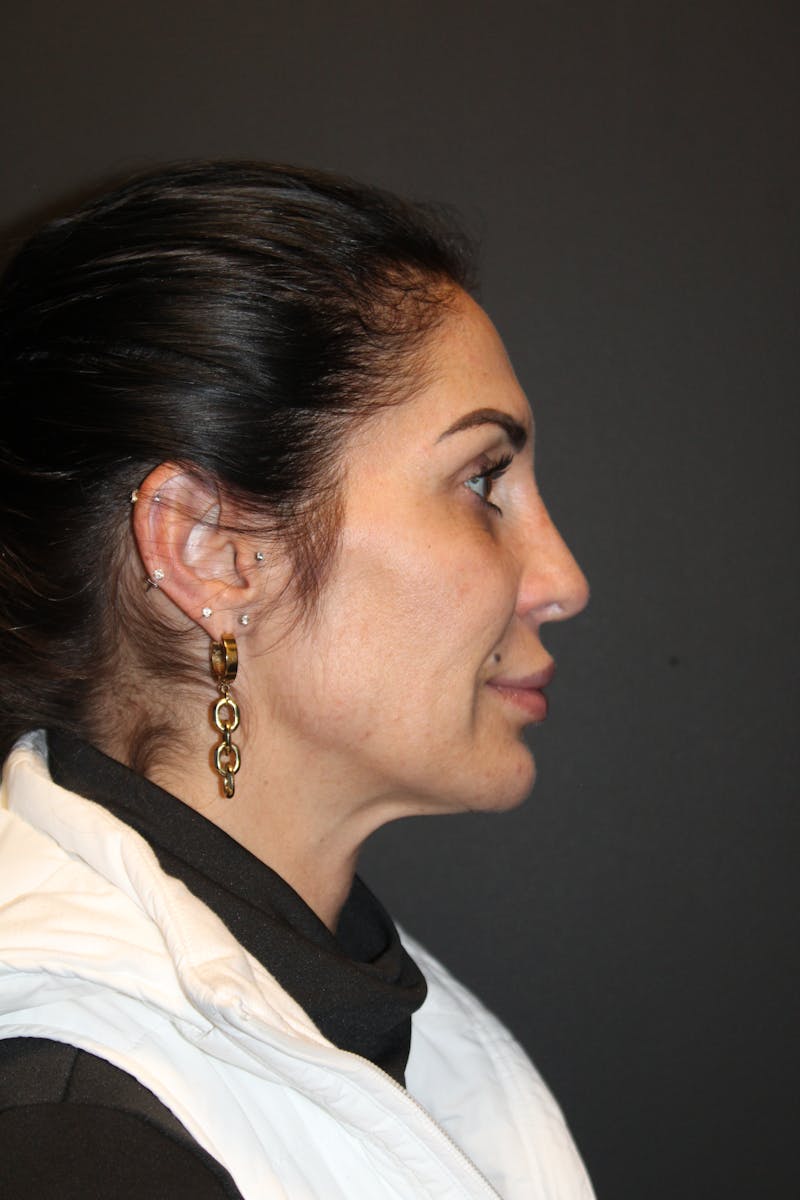 Facelift & Necklift Before & After Gallery - Patient 842820 - Image 3
