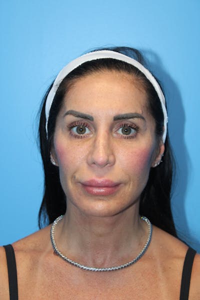 Facelift & Necklift Before & After Gallery - Patient 842820 - Image 2