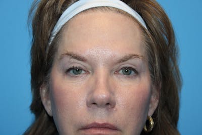 Eye Surgery Before & After Gallery - Patient 770725 - Image 2