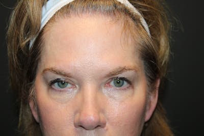 Eye Surgery Before & After Gallery - Patient 770725 - Image 1