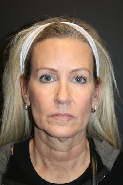 Facelift & Necklift Before & After Gallery - Patient 371767 - Image 1