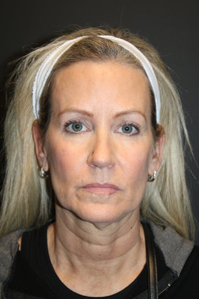 SWIFT LIFT ® / Facelift / Necklift  Before & After Gallery - Patient 371767 - Image 1