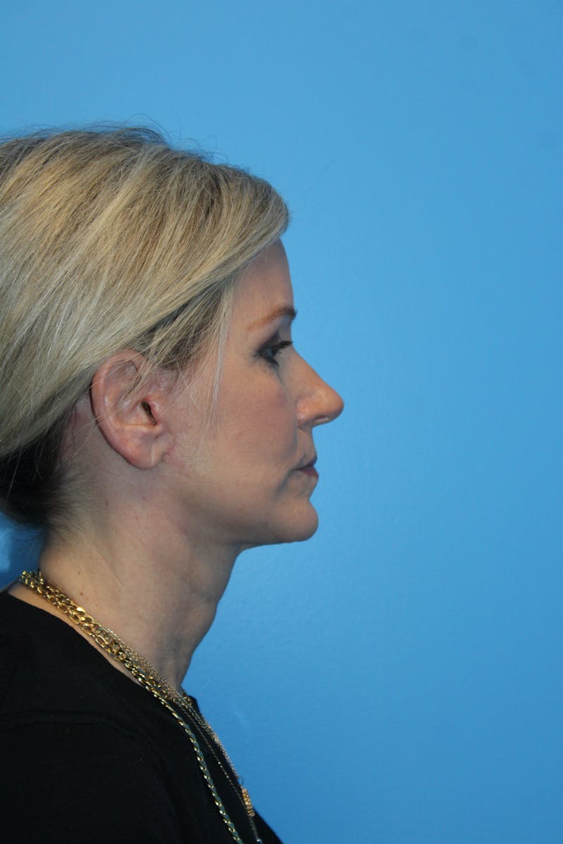 SWIFT LIFT ® / Facelift / Necklift  Before & After Gallery - Patient 371767 - Image 4