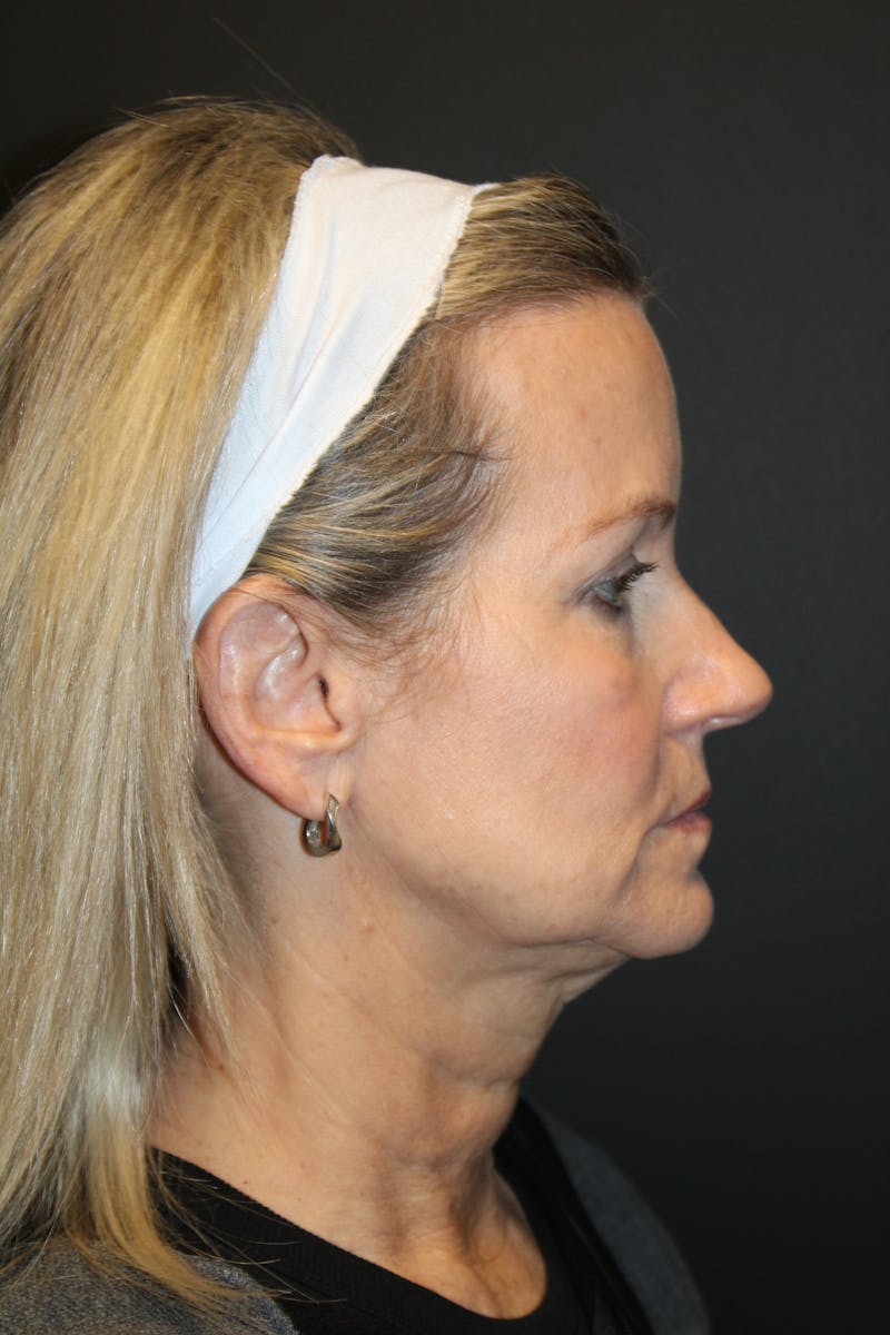 SWIFT LIFT ® / Facelift / Necklift  Before & After Gallery - Patient 371767 - Image 3