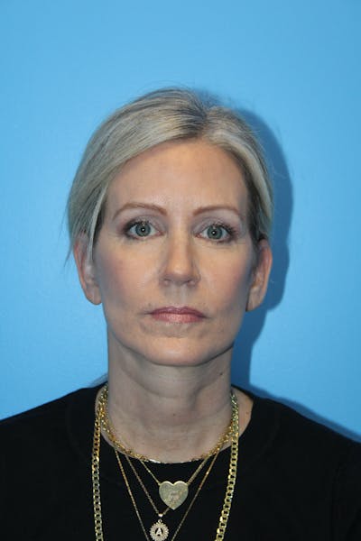 Facelift & Necklift Before & After Gallery - Patient 371767 - Image 2