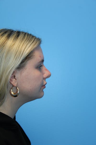 Rhinoplasty Before & After Gallery - Patient 674083 - Image 2