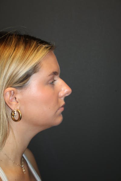 Rhinoplasty Before & After Gallery - Patient 674083 - Image 1
