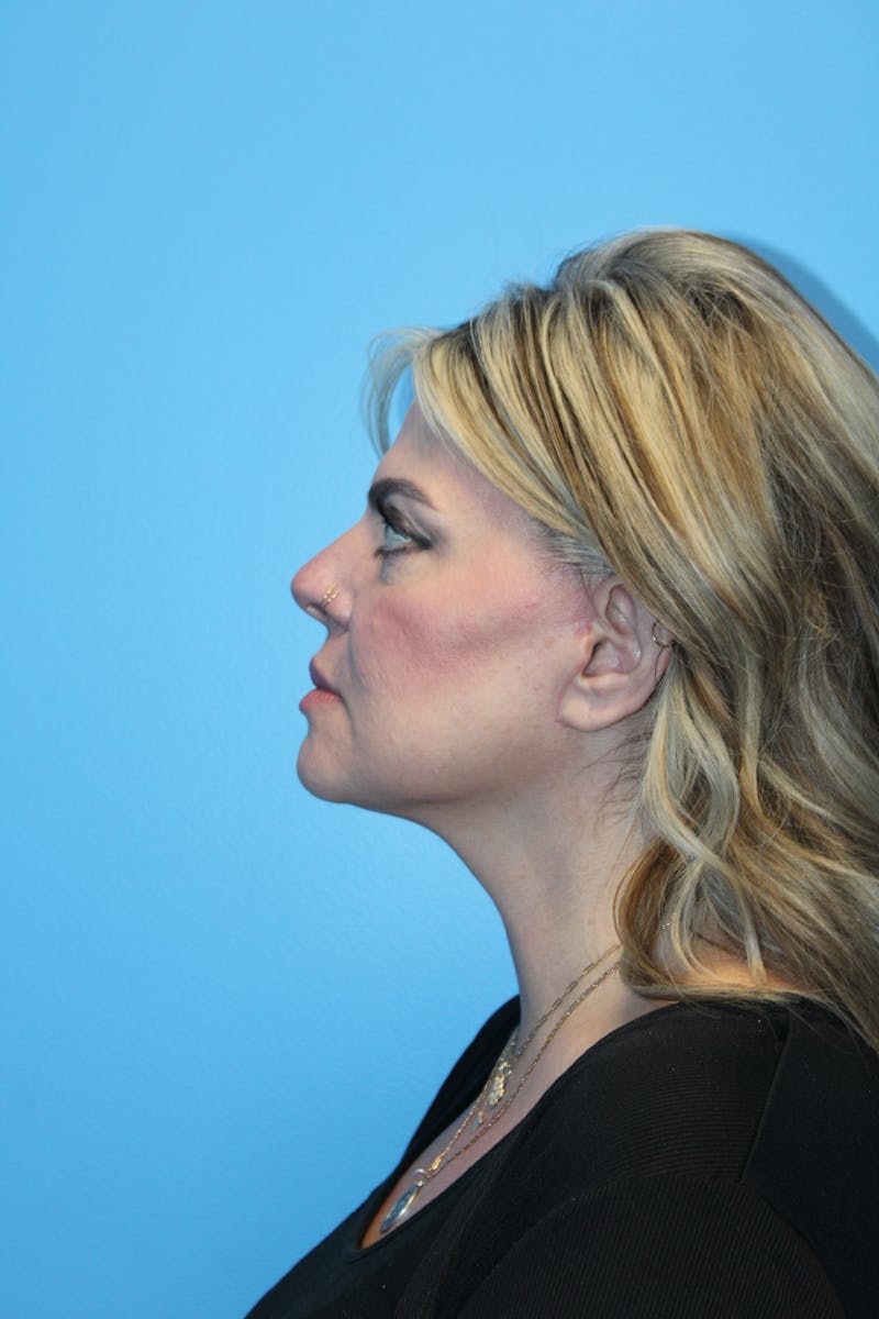 SWIFT LIFT ® / Facelift / Necklift  Before & After Gallery - Patient 234942 - Image 4