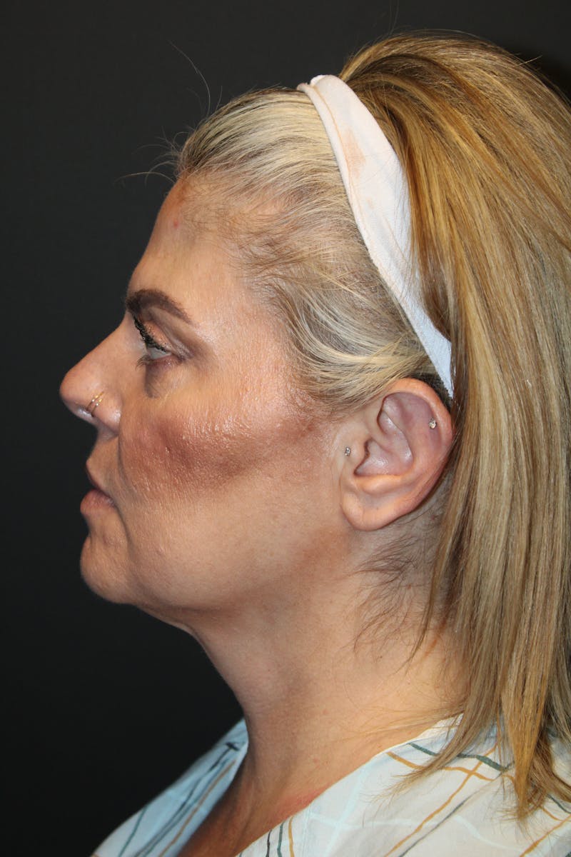 SWIFT LIFT ® / Facelift / Necklift  Before & After Gallery - Patient 234942 - Image 3