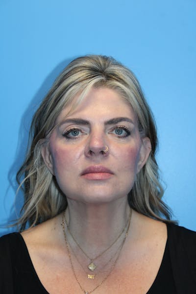 SWIFT LIFT ® / Facelift / Necklift  Before & After Gallery - Patient 234942 - Image 2