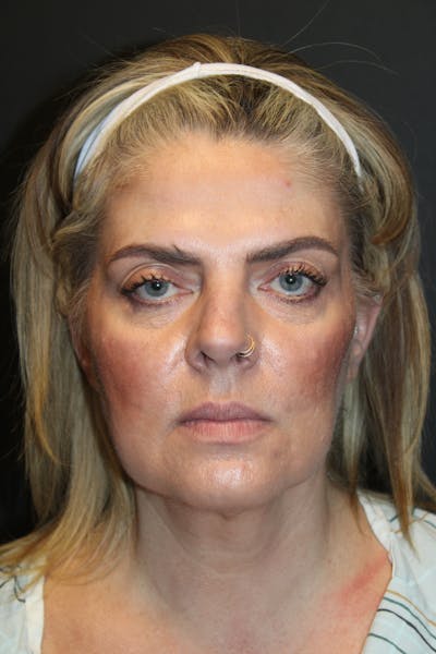 SWIFT LIFT ® / Facelift / Necklift  Before & After Gallery - Patient 234942 - Image 1