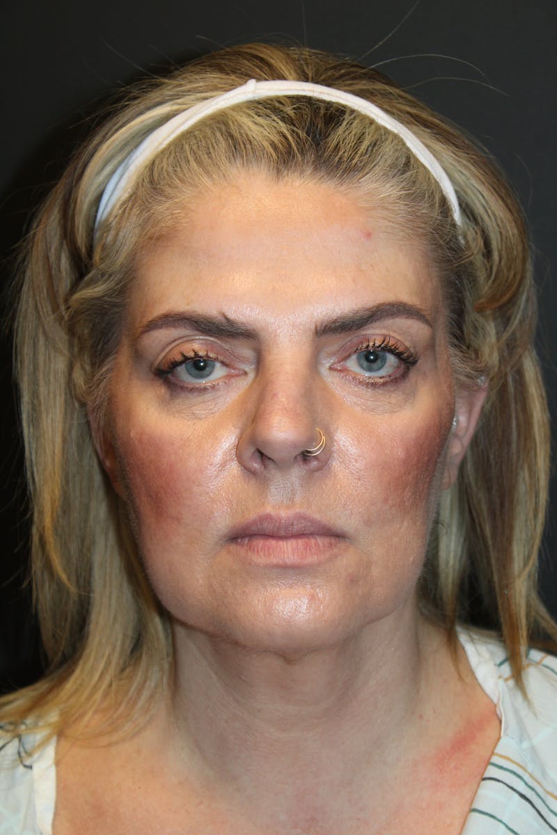 SWIFT LIFT ® / Facelift / Necklift  Before & After Gallery - Patient 234942 - Image 1