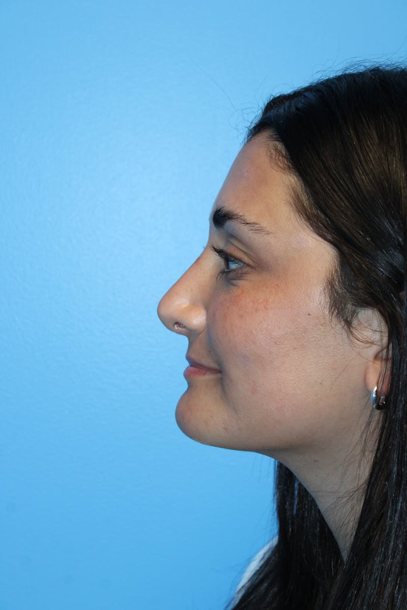 Rhinoplasty Before & After Gallery - Patient 382663 - Image 4