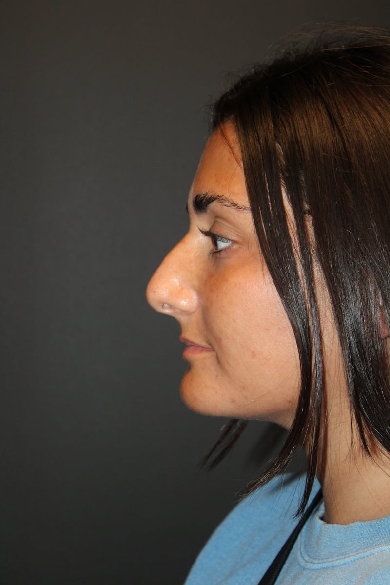 Rhinoplasty Before & After Gallery - Patient 382663 - Image 3