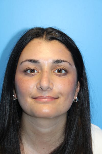 Rhinoplasty Before & After Gallery - Patient 382663 - Image 2