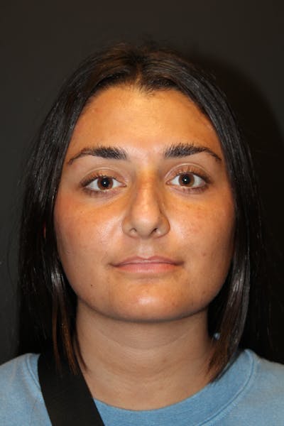 Rhinoplasty Before & After Gallery - Patient 382663 - Image 1