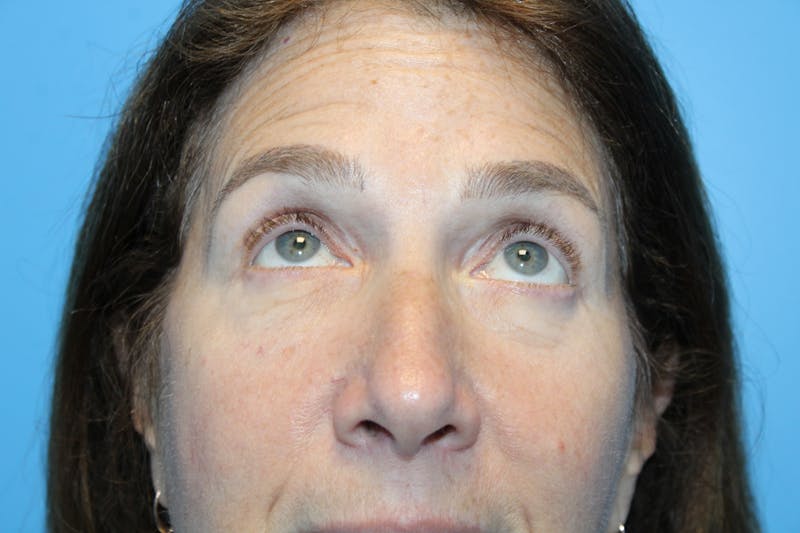 Eye Surgery Before & After Gallery - Patient 406785 - Image 4
