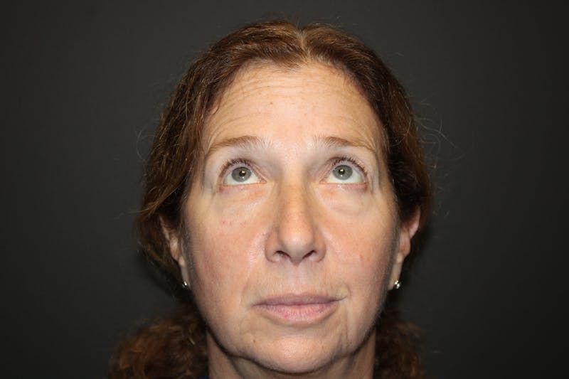 Eye Surgery Before & After Gallery - Patient 406785 - Image 3