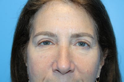 Eye Surgery Before & After Gallery - Patient 406785 - Image 2