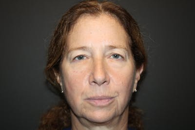 Eye Surgery Before & After Gallery - Patient 406785 - Image 1